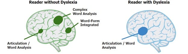 Dyslexia brain 2